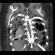Malposition of nasogastric tube, hemothorax, pneumothorax: CT - Computed tomography